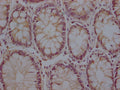 IHC image of CSB-PA29809A0Rb diluted at 1:200 and staining in paraffin-embedded human colon cancer performed on a Leica BondTM system. After dewaxing and hydration, antigen retrieval was mediated by high pressure in a citrate buffer (pH 6.0). Section was blocked with 10% normal goat serum 30min at RT. Then primary antibody (1% BSA) was incubated at 4°C overnight. The primary is detected by a Goat anti-rabbit polymer IgG labeled by HRP and visualized using 0.05% DAB.