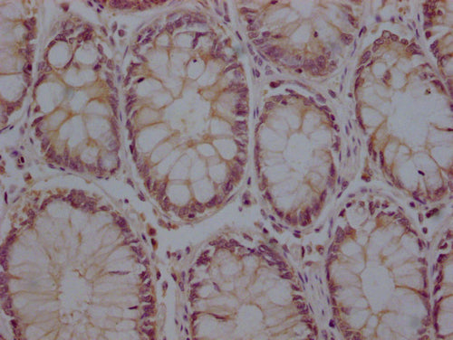 IHC image of CSB-PA29809A0Rb diluted at 1:200 and staining in paraffin-embedded human colon cancer performed on a Leica BondTM system. After dewaxing and hydration, antigen retrieval was mediated by high pressure in a citrate buffer (pH 6.0). Section was blocked with 10% normal goat serum 30min at RT. Then primary antibody (1% BSA) was incubated at 4°C overnight. The primary is detected by a Goat anti-rabbit polymer IgG labeled by HRP and visualized using 0.05% DAB.