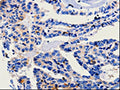 The image on the left is immunohistochemistry of paraffin-embedded Human thyroid cancer tissue using CSB-PA298167(CA3 Antibody) at dilution 1/25, on the right is treated with fusion protein. (Original magnification: ×200)