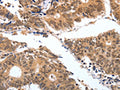 The image on the left is immunohistochemistry of paraffin-embedded Human colon cancer tissue using CSB-PA298172(PGC Antibody) at dilution 1/25, on the right is treated with fusion protein. (Original magnification: ×200)
