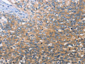The image on the left is immunohistochemistry of paraffin-embedded Human cervical cancer tissue using CSB-PA298431(BRE Antibody) at dilution 1/30, on the right is treated with fusion protein. (Original magnification: ×200)