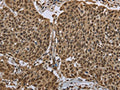 The image on the left is immunohistochemistry of paraffin-embedded Human cervical cancer tissue using CSB-PA298674(PPAT Antibody) at dilution 1/50, on the right is treated with fusion protein. (Original magnification: ×200)