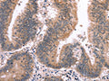 The image on the left is immunohistochemistry of paraffin-embedded Human colon cancer tissue using CSB-PA299002(MAPK13 Antibody) at dilution 1/15, on the right is treated with synthetic peptide. (Original magnification: ×200)