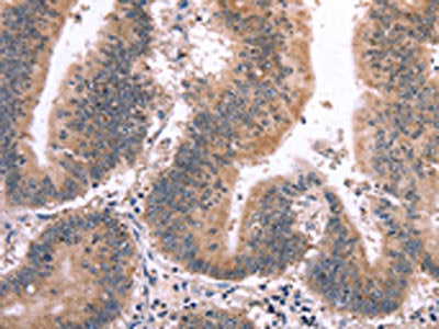 The image on the left is immunohistochemistry of paraffin-embedded Human colon cancer tissue using CSB-PA299002(MAPK13 Antibody) at dilution 1/15, on the right is treated with synthetic peptide. (Original magnification: ×200)