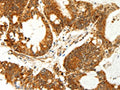 The image on the left is immunohistochemistry of paraffin-embedded Human colon cancer tissue using CSB-PA299234(COX7B Antibody) at dilution 1/60, on the right is treated with fusion protein. (Original magnification: ×200)