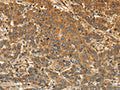 The image on the left is immunohistochemistry of paraffin-embedded Human liver cancer tissue using CSB-PA299262(EDNRA Antibody) at dilution 1/30, on the right is treated with synthetic peptide. (Original magnification: ×200)