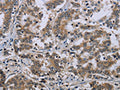 The image on the left is immunohistochemistry of paraffin-embedded Human liver cancer tissue using CSB-PA299522(NEFH Antibody) at dilution 1/35, on the right is treated with synthetic peptide. (Original magnification: ×200)