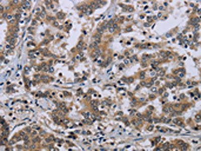 The image on the left is immunohistochemistry of paraffin-embedded Human liver cancer tissue using CSB-PA299522(NEFH Antibody) at dilution 1/35, on the right is treated with synthetic peptide. (Original magnification: ×200)