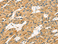 The image on the left is immunohistochemistry of paraffin-embedded Human liver cancer tissue using CSB-PA302315(MAPK12 Antibody) at dilution 1/25, on the right is treated with fusion protein. (Original magnification: ×200)