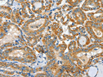 The image on the left is immunohistochemistry of paraffin-embedded Human thyroid cancer tissue using CSB-PA305079(ASCC1 Antibody) at dilution 1/30, on the right is treated with fusion protein. (Original magnification: ×200)