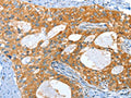 The image on the left is immunohistochemistry of paraffin-embedded Human cervical cancer tissue using CSB-PA311389(AMHR2 Antibody) at dilution 1/40, on the right is treated with fusion protein. (Original magnification: ×200)