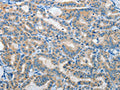 The image on the left is immunohistochemistry of paraffin-embedded Human thyroid cancer tissue using CSB-PA313276(IL21R Antibody) at dilution 1/40, on the right is treated with fusion protein. (Original magnification: ×200)