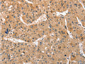 The image on the left is immunohistochemistry of paraffin-embedded Human liver cancer tissue using CSB-PA313566(ATG12 Antibody) at dilution 1/70, on the right is treated with fusion protein. (Original magnification: ×200)
