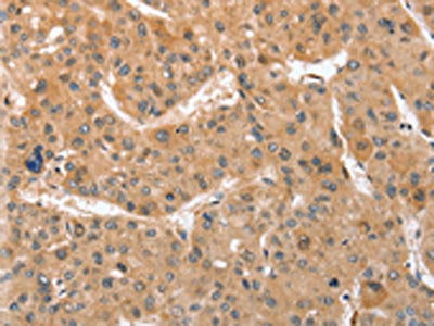 The image on the left is immunohistochemistry of paraffin-embedded Human liver cancer tissue using CSB-PA313566(ATG12 Antibody) at dilution 1/70, on the right is treated with fusion protein. (Original magnification: ×200)