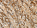 The image on the left is immunohistochemistry of paraffin-embedded Human gastic cancer tissue using CSB-PA314121(CALR Antibody) at dilution 1/50, on the right is treated with fusion protein. (Original magnification: ×200)