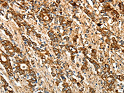 The image on the left is immunohistochemistry of paraffin-embedded Human gastic cancer tissue using CSB-PA314121(CALR Antibody) at dilution 1/50, on the right is treated with fusion protein. (Original magnification: ×200)