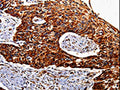 The image is immunohistochemistry of paraffin-embedded Human esophagus cancer tissue using CSB-PA316039(IL17RC Antibody) at dilution 1/20. (Original magnification: ×200)