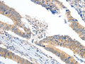 The image on the left is immunohistochemistry of paraffin-embedded Human colon cancer tissue using CSB-PA318254(APOB Antibody) at dilution 1/10, on the right is treated with synthetic peptide. (Original magnification: ×200)