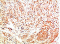 Immunohistochemical analysis of paraffin-embedded Human Breast Carcinoma Tissue using ERK1 Rabbit pAb diluted at 1:500