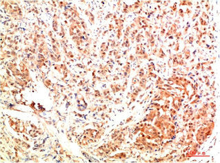 Immunohistochemical analysis of paraffin-embedded Human Breast Carcinoma Tissue using ERK1 Rabbit pAb diluted at 1:500