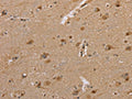 The image on the left is immunohistochemistry of paraffin-embedded Human brain tissue using CSB-PA324006(DLD Antibody) at dilution 1/35, on the right is treated with fusion protein. (Original magnification: ×200)