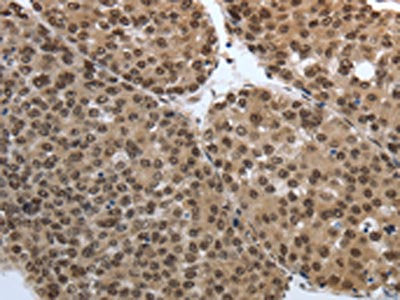 The image on the left is immunohistochemistry of paraffin-embedded Human liver cancer tissue using CSB-PA324386(SMAD7 Antibody) at dilution 1/40, on the right is treated with synthetic peptide. (Original magnification: ×200)