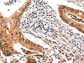 The image on the left is immunohistochemistry of paraffin-embedded Human colon cancer tissue using CSB-PA325213(ERBB3 Antibody) at dilution 1/35, on the right is treated with fusion protein. (Original magnification: ×200)