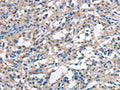 The image on the left is immunohistochemistry of paraffin-embedded Human thyroid cancer tissue using CSB-PA325565(ANAPC1 Antibody) at dilution 1/30, on the right is treated with synthetic peptide. (Original magnification: ×200)
