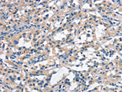 The image on the left is immunohistochemistry of paraffin-embedded Human thyroid cancer tissue using CSB-PA325565(ANAPC1 Antibody) at dilution 1/30, on the right is treated with synthetic peptide. (Original magnification: ×200)