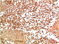 Immunohistochemical analysis of paraffin-embedded Human Lung Carcinoma Tissue using HSP90α Rabbit pAb diluted at 1:200