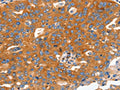 The image on the left is immunohistochemistry of paraffin-embedded Human ovarian cancer tissue using CSB-PA332497(CAP2 Antibody) at dilution 1/60, on the right is treated with fusion protein. (Original magnification: ×200)