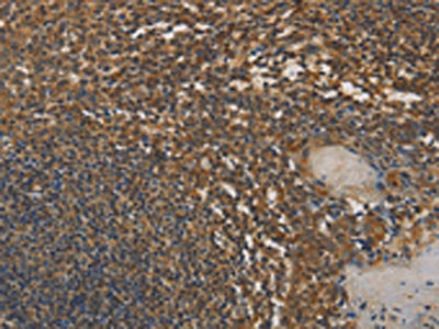 The image on the left is immunohistochemistry of paraffin-embedded Human tonsil tissue using CSB-PA337435(DAB2 Antibody) at dilution 1/25, on the right is treated with fusion protein. (Original magnification: ×200)