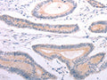 The image on the left is immunohistochemistry of paraffin-embedded Human colon cancer tissue using CSB-PA337817(ANGPTL2 Antibody) at dilution 1/20, on the right is treated with synthetic peptide. (Original magnification: ×200)