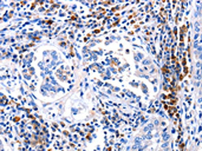 The image on the left is immunohistochemistry of paraffin-embedded Human lung cancer tissue using CSB-PA338014(DOK3 Antibody) at dilution 1/25, on the right is treated with fusion protein. (Original magnification: ×200)