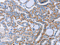 The image on the left is immunohistochemistry of paraffin-embedded Human thyroid cancer tissue using CSB-PA338217(KIF3A Antibody) at dilution 1/40, on the right is treated with fusion protein. (Original magnification: ×200)