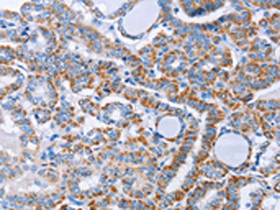 The image on the left is immunohistochemistry of paraffin-embedded Human thyroid cancer tissue using CSB-PA338217(KIF3A Antibody) at dilution 1/40, on the right is treated with fusion protein. (Original magnification: ×200)