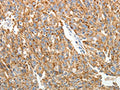 The image on the left is immunohistochemistry of paraffin-embedded Human ovarian cancer tissue using CSB-PA345280(COL4A3 Antibody) at dilution 1/20, on the right is treated with synthetic peptide. (Original magnification: ×200)