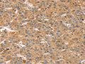 The image on the left is immunohistochemistry of paraffin-embedded Human liver cancer tissue using CSB-PA346002(CAPN7 Antibody) at dilution 1/20, on the right is treated with fusion protein. (Original magnification: ×200)