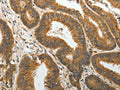 The image on the left is immunohistochemistry of paraffin-embedded Human colon cancer tissue using CSB-PA350868(PTP4A2 Antibody) at dilution 1/25, on the right is treated with fusion protein. (Original magnification: ×200)