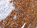 The image on the left is immunohistochemistry of paraffin-embedded Human cervical cancer tissue using CSB-PA354357(ABCA4 Antibody) at dilution 1/25, on the right is treated with synthetic peptide. (Original magnification: ×200)