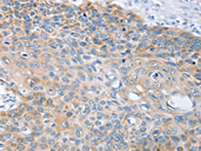 The image on the left is immunohistochemistry of paraffin-embedded Human esophagus cancer tissue using CSB-PA354431(RNF185 Antibody) at dilution 1/25, on the right is treated with fusion protein. (Original magnification: ×200)