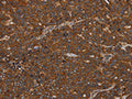 The image on the left is immunohistochemistry of paraffin-embedded Human ovarian cancer tissue using CSB-PA356766(GDF2 Antibody) at dilution 1/40, on the right is treated with synthetic peptide. (Original magnification: ×200)