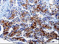 The image on the left is immunohistochemistry of paraffin-embedded Human liver cancer tissue using CSB-PA358768(FTH1 Antibody) at dilution 1/10, on the right is treated with fusion protein. (Original magnification: ×200)