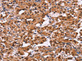The image on the left is immunohistochemistry of paraffin-embedded Human thyroid cancer tissue using CSB-PA360041(XPO1 Antibody) at dilution 1/25, on the right is treated with fusion protein. (Original magnification: ×200)