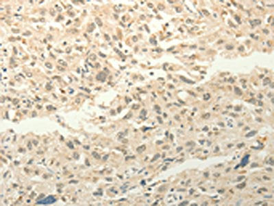 The image on the left is immunohistochemistry of paraffin-embedded Human esophagus cancer tissue using CSB-PA360153(FZD8 Antibody) at dilution 1/50, on the right is treated with synthetic peptide. (Original magnification: ×200)
