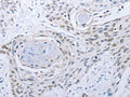The image on the left is immunohistochemistry of paraffin-embedded Human esophagus cancer tissue using CSB-PA362118(CAMK2B Antibody) at dilution 1/25, on the right is treated with fusion protein. (Original magnification: ×200)