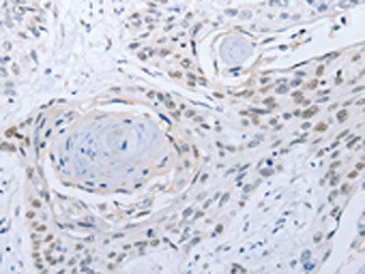 The image on the left is immunohistochemistry of paraffin-embedded Human esophagus cancer tissue using CSB-PA362118(CAMK2B Antibody) at dilution 1/25, on the right is treated with fusion protein. (Original magnification: ×200)