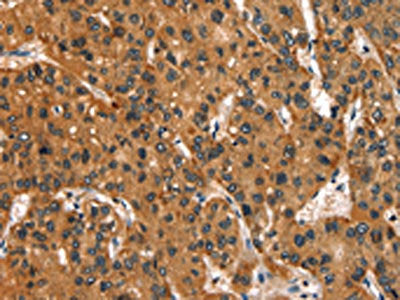 The image is immunohistochemistry of paraffin-embedded Human liver cancer tissue using CSB-PA363564(SLC6A4 Antibody) at dilution 1/50. (Original magnification: ×200)