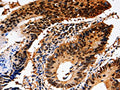 The image on the left is immunohistochemistry of paraffin-embedded Human colon cancer tissue using CSB-PA363619(YWHAE Antibody) at dilution 1/10, on the right is treated with fusion protein. (Original magnification: ×200)