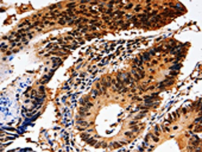 The image on the left is immunohistochemistry of paraffin-embedded Human colon cancer tissue using CSB-PA363619(YWHAE Antibody) at dilution 1/10, on the right is treated with fusion protein. (Original magnification: ×200)
